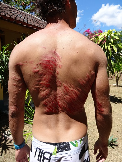 SUMBAWA SURF ACCIDENT CORAIL